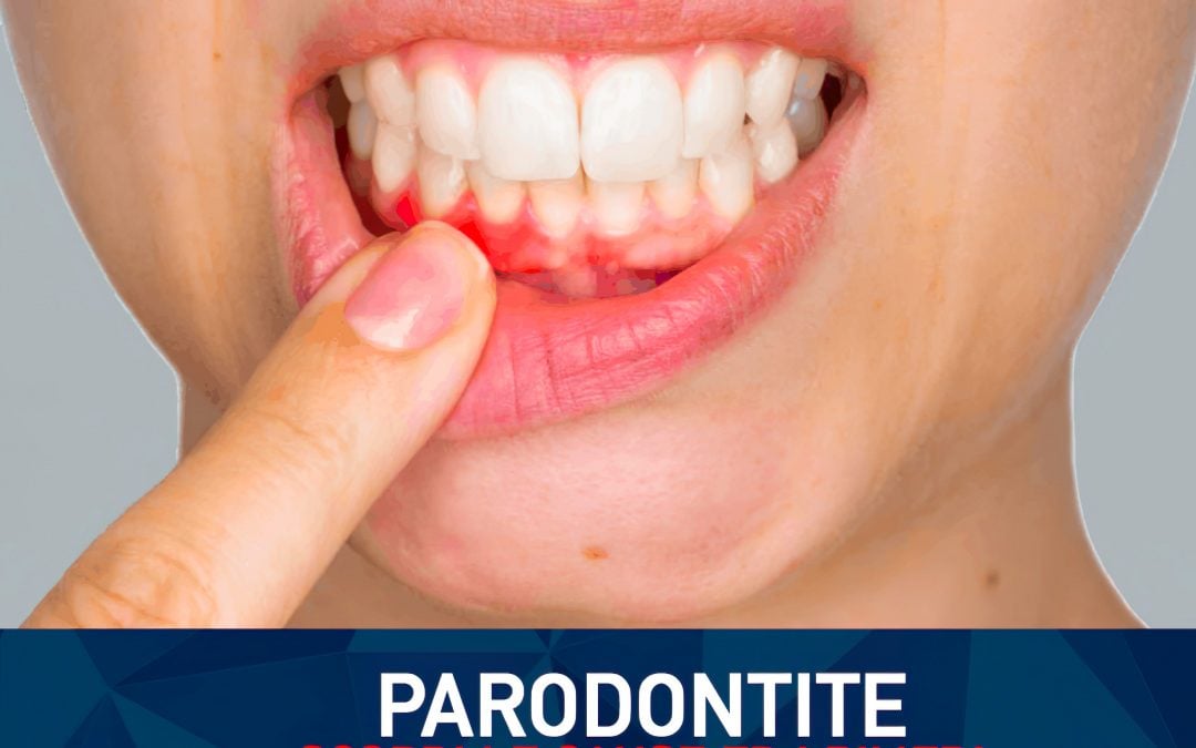 Smog e caldo sotto accusa: la parodontite diventa l’allarme silenzioso della salute orale